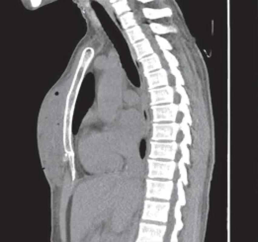 Initial CT scan – implants, pre-implants collection, gas bubbles and reactive pleural eff usion.