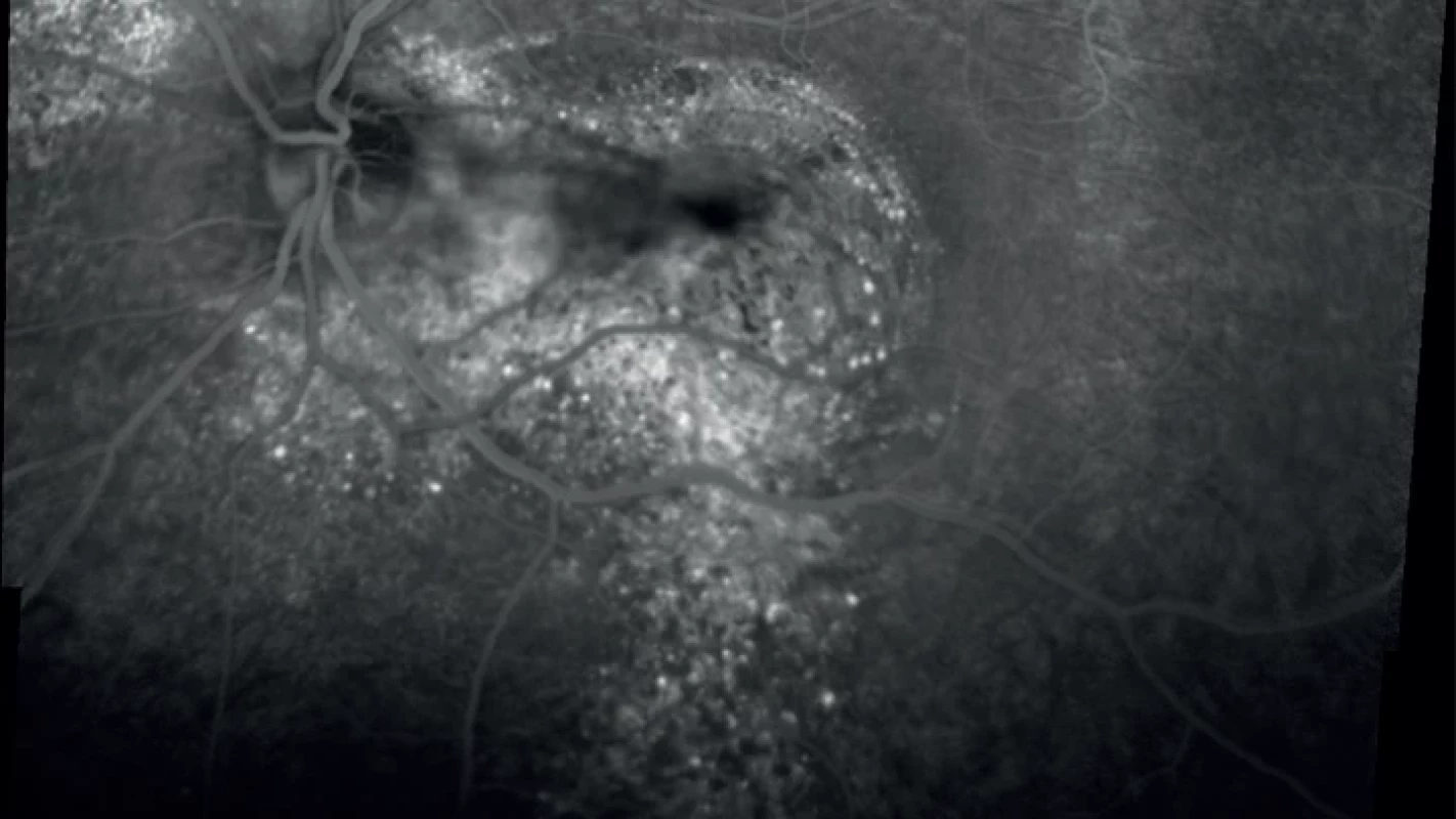 Fluorescein angiography of a 54-year-old patient with a chronic form of central serous chorioretinopathy (Heidelberg Spectralis, Myslík Manethová):