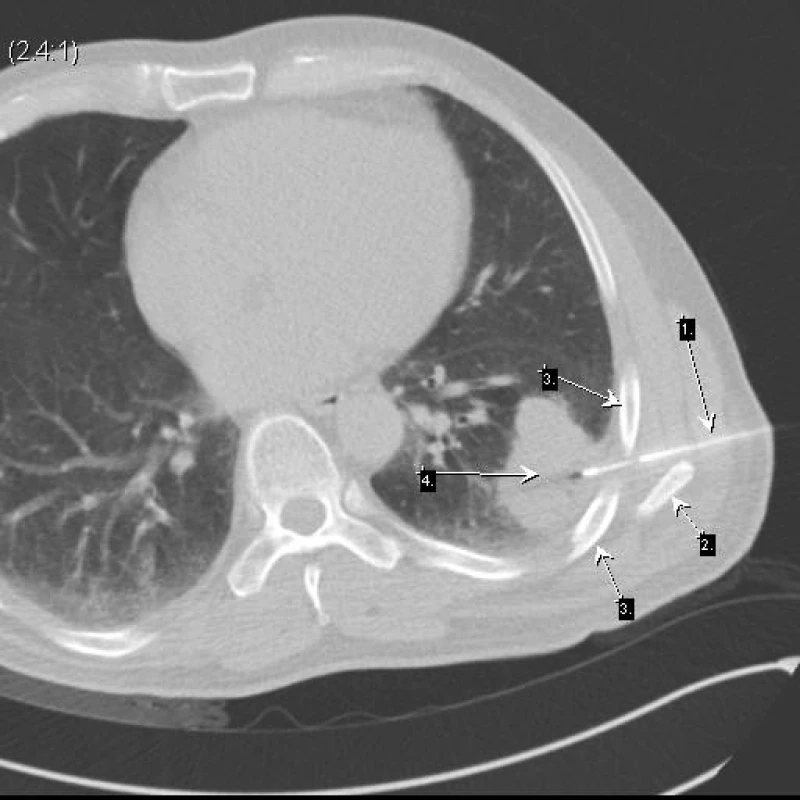 Bioptická jehla (šipka 1) probíhající v úzkém prostoru mezi skeletem žeber (šipka 3) v průběhu dolního okraje lopatky (šipka 2)
Cíleno do oblasti ložiska (šipka 4) v místě kontaktu s pleurou mimo vzdušnou plíci. Neuroendokrinní karcinom.