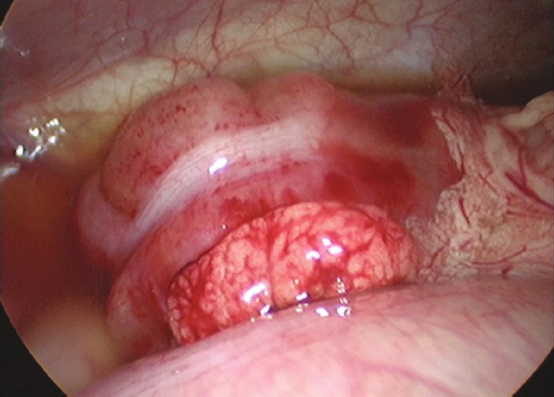 Laparoskopický peroperačný nález ileocékalnej invaginácie (foto: V. Cingel)
Fig. 1. Laparoscopic intraoperative finding of ileocaecal invagination (photo: V. Cingel)