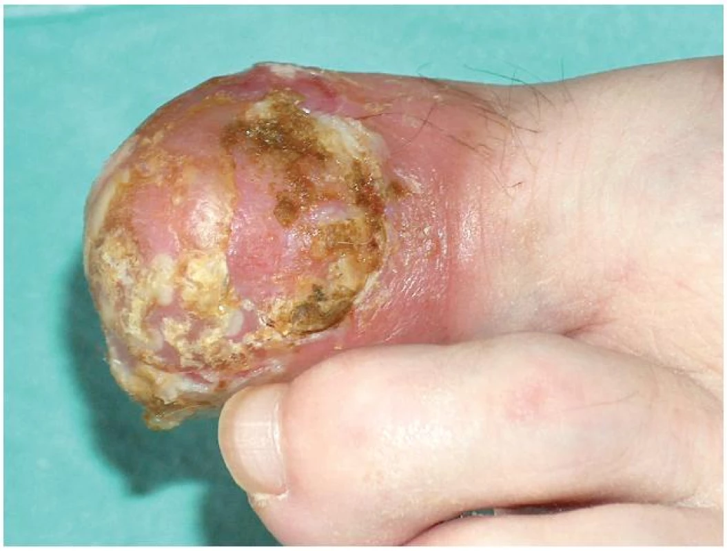 Pustulózní psoriáza s destrukcí nehtu po terbinafinu 
Pacientka měla původně minimální psoriatická ložiska na predilekčních místech.
