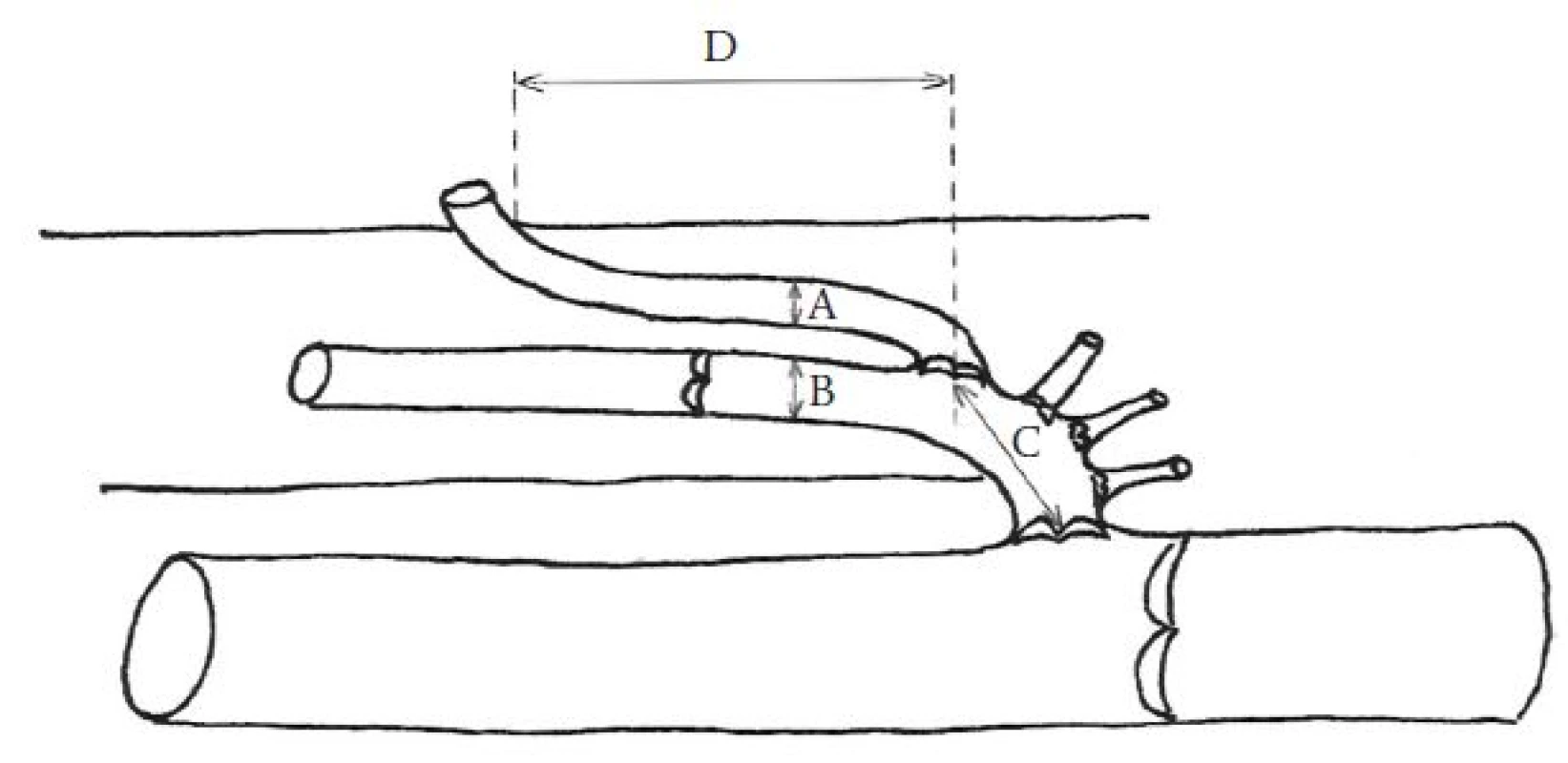 Měřené anatomické parametry PPVS.