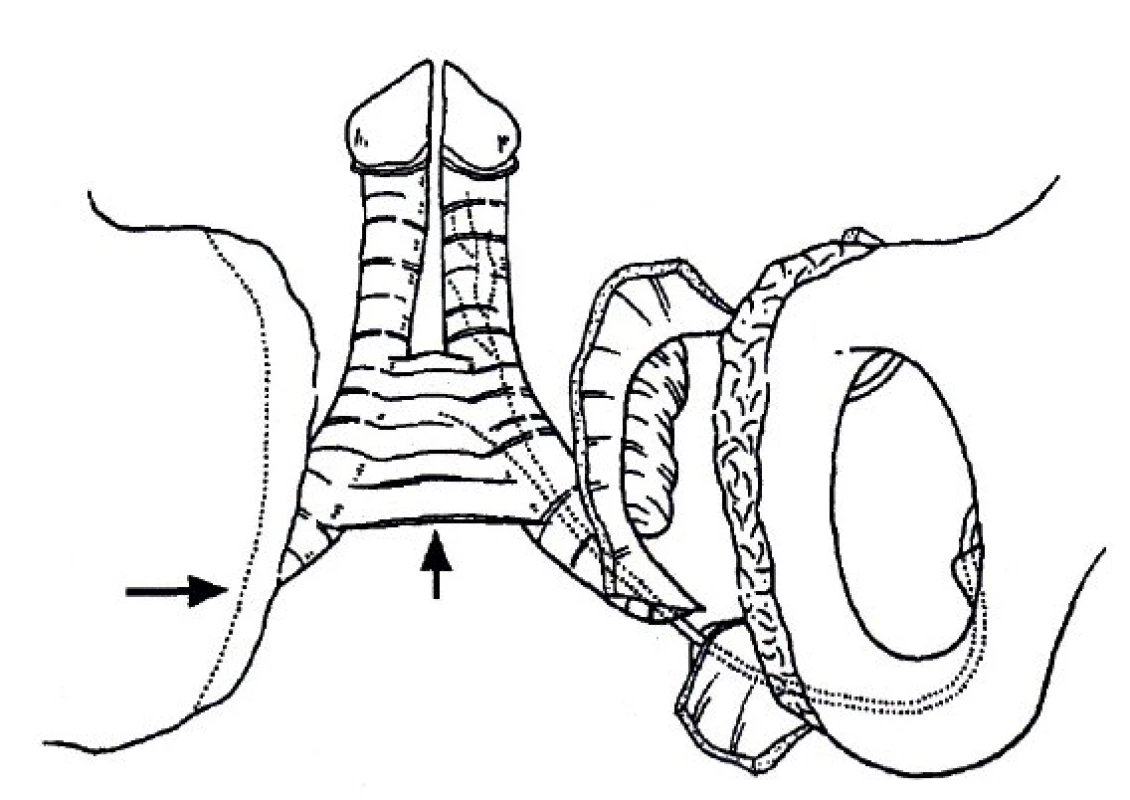 Schéma mobilizace měkkých tkání s preparací periostu pubických kostí dle Kellyho.
Fig. 6. Extended mobilisation of soft tissues after Kelly.