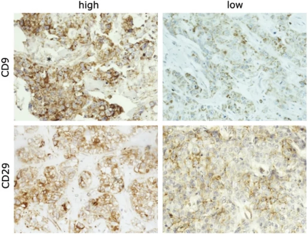 An example of high expression of CD9 in the primary tumor and low level in the lymph node metastasis from the same patient.