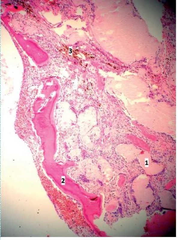 Stěna ureteru a pánvičky s depozity amyloidu a lamelami metaplastické osifikace: 1 – amyloid, 2 – lamelky metaplastické osifikace, 3 – hemosiderin (barvení Fraser, zvětšení 100×)
Fig. 2. The wall of the ureter and pelvis kidney with amyloid deposits and metaplastic calcification: 1 – amyloid, 2 – plates of metaplastic calcification, 3 – hemosiderin (Fraser staining, magnification 100×)