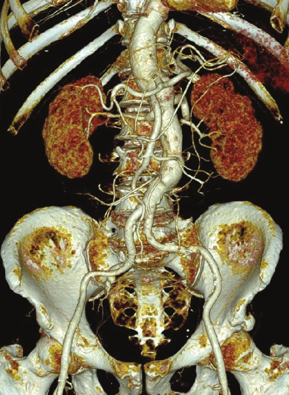 CTA kontrola po 3 letech od výkonu
Fig. 8: Follow-up CTA 3 years after surgery