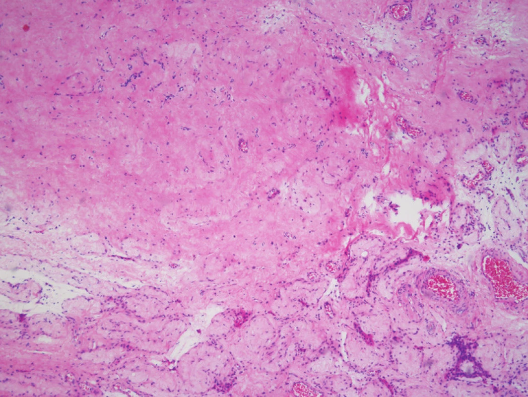 Histologický nález lézie v pravom semenníku potvrdil jazvovitý parenchým testis s atrofickými zmenami v okolitých semenotvorných kanálikoch (zväčšenie 40×; farbenie hematoxylín – eozín)
Fig. 2. Histologically, the lesion from the right testis was composed of scarred testicular tissue with atrophic changes in surrounding seminiferous tubules (magnification 40×; hematoxylin – eosin staining)