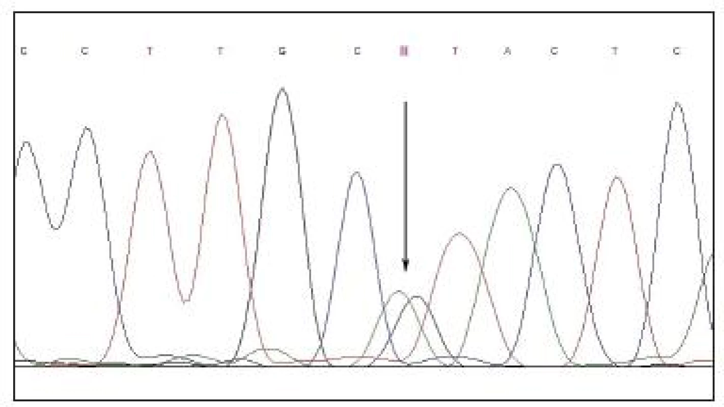 Sekvenční chromatogram. Heterozygotní záměna guaninu za adenosin (c.653G>A) v genu BEST1 u probanda s minimálním nálezem na fundu svědčícím pro přítomnost Bestovy choroby. Použitá nomenklatura odpovídá doporučení Společnosti pro variabilitu lidského genomu, přičemž adenosin z ATG-translačního iniciačního kodonu je uváděn jako nukleotid 1 (11, 2). Za referenční byla považována sekvence NM_004183.2