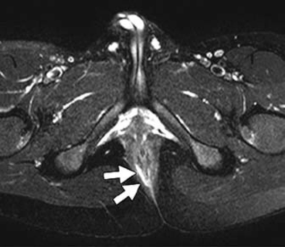 Magnetická rezonance perianální oblasti s patrnou transsfinkterickou píštělí (šipky).
Fig. 2. Magnetic resonance of perianal region with transsfincteric fistula (arrows).