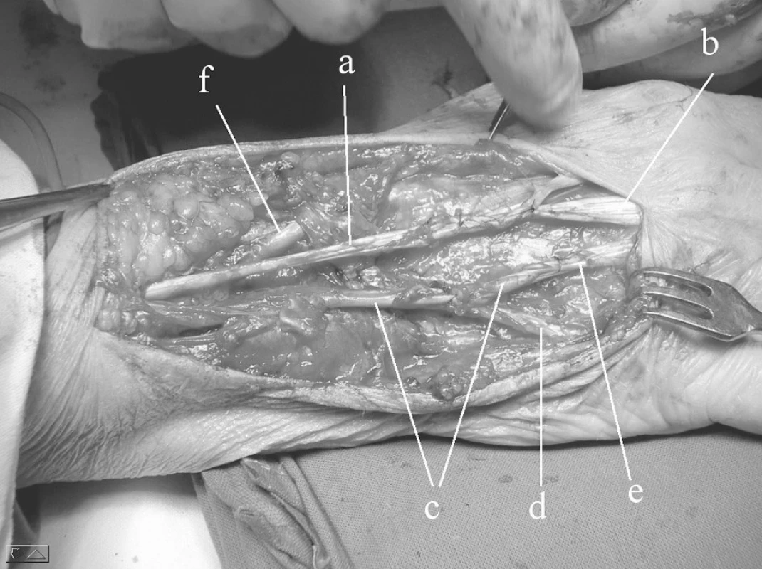 Operační nález šlach po ošetření: a) m.extensor dig. II.,
b) distální pahýl extenzoru 3. prstu, 
c) transponovaná šlacha m. extensor indicis proprius, 
d) distální pahýl extenzoru 5. prstu, 
e) distální pahýl exzenzoru 4. prstu,
f) šlacha m. extensor pollicis longus (nepoškozený)