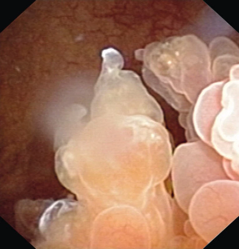 Cystoskopie před operací
Fig. 2. Cystoscopy prior TUR