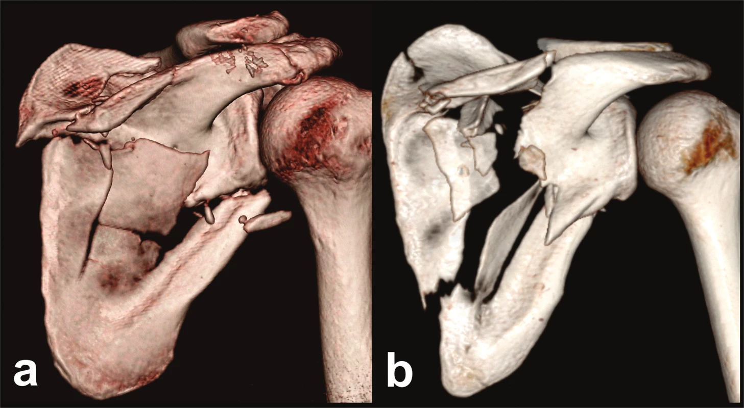 Types of fractures of both pillars
a – fracture involving the medial third of the spinal pillar, b – fracture involving the central part of the spinal pillar.