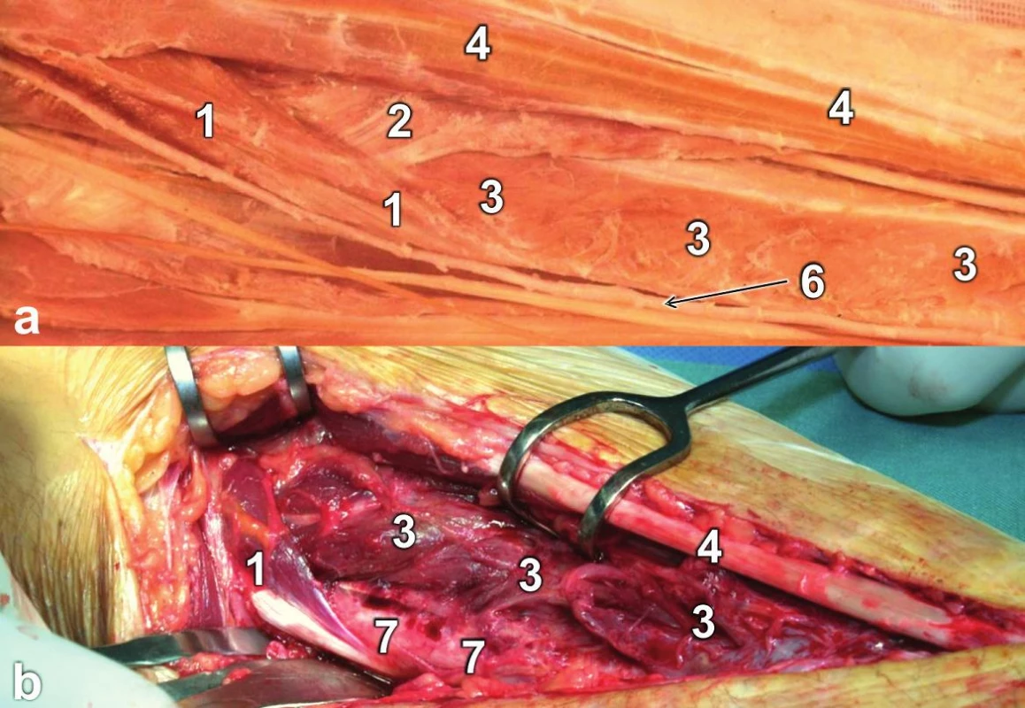 Oblast úponu m. pronator teres: a – anatomický preparát (pravá strana); b – peroperační situace: 1 – m. pronator teres, 2 – m. flexor digitorum superficialis (caput radiale), 3 – m. flexor pollicis longus, 4 – m. flexor carpi radialis, 6 – a. radialis, 7 – diafýza radia.
Fig. 6: Site of insertion of the pronator teres: a – anatomical specimen (right side); b – intraoperative view: 1 – pronator teres, 2 – flexor digitorum superficialis (radial head), 3 – flexor pollicis longus, 4 – flexor carpi radialis, 6 – radial artery 7 – radial shaft.