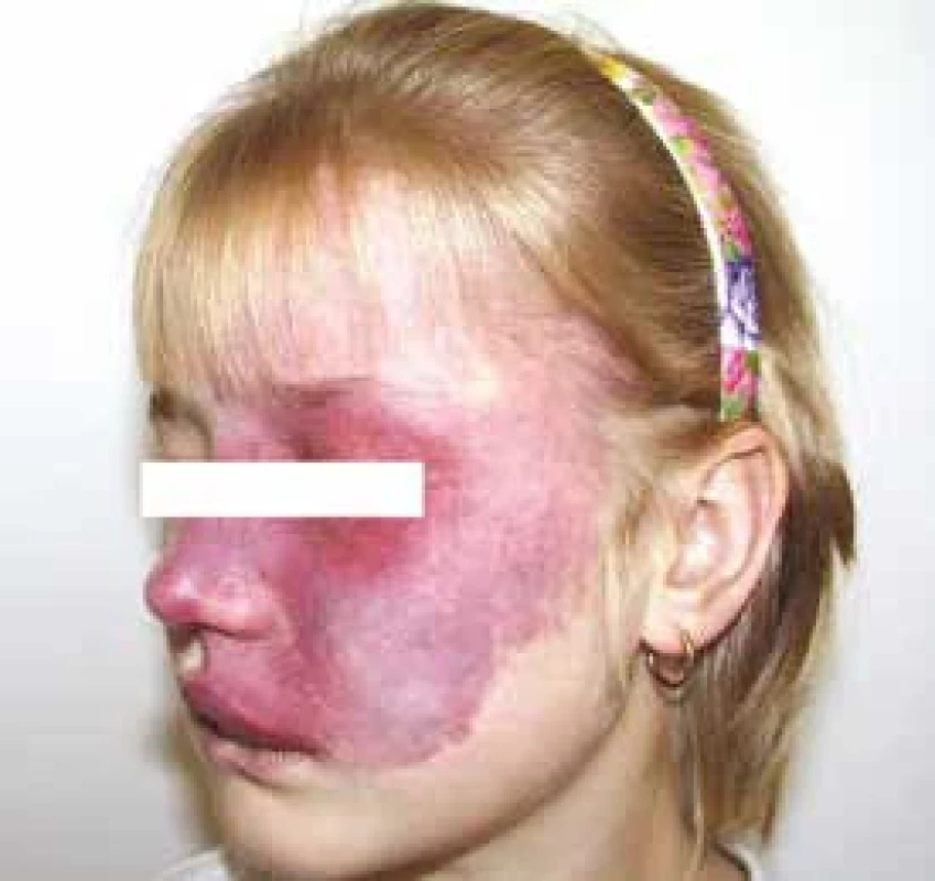 Sturge-Weber syndrom