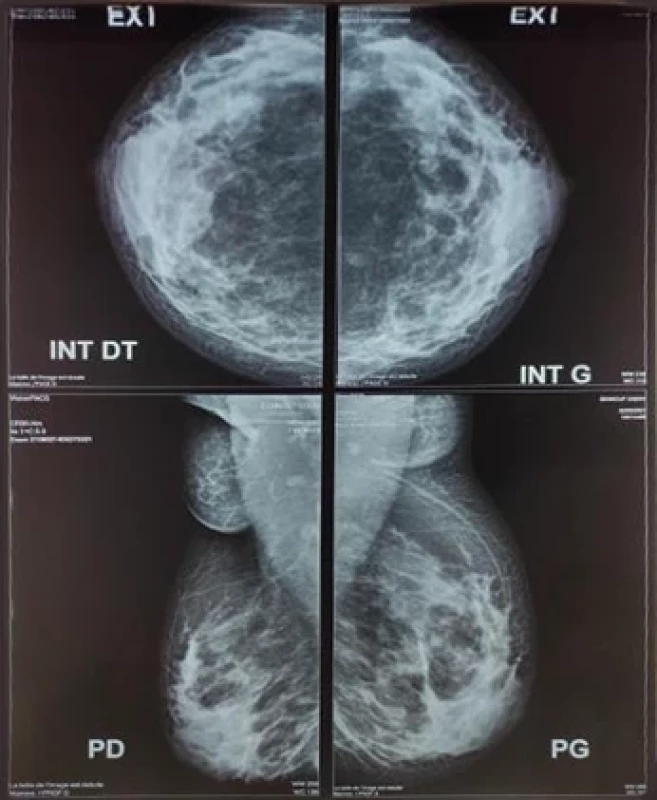 Ultrasound (echo-mammo) of the patient's bilateral supernumerary breasts: additional breast tissues in the axillary region have a homogeneous appearance, with ultrasound features consistent with normal breast tissues. There are no suspicious masses, abnormal microcalcifi cations, or signs of abnormal vascularity that could suggest malignancy.
