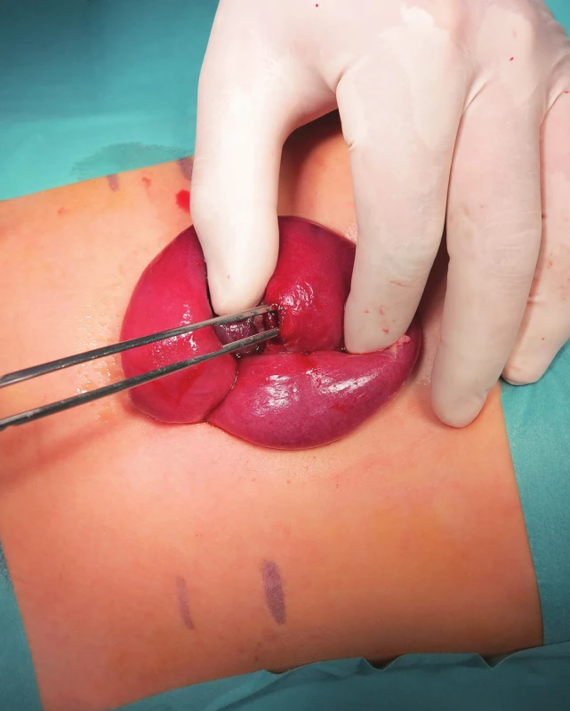 Enlarging of umbilical incision: externalization of the intestine with a perforation in front of the abdominal cavity; the lesion was closed with an interrupted two layers suture.