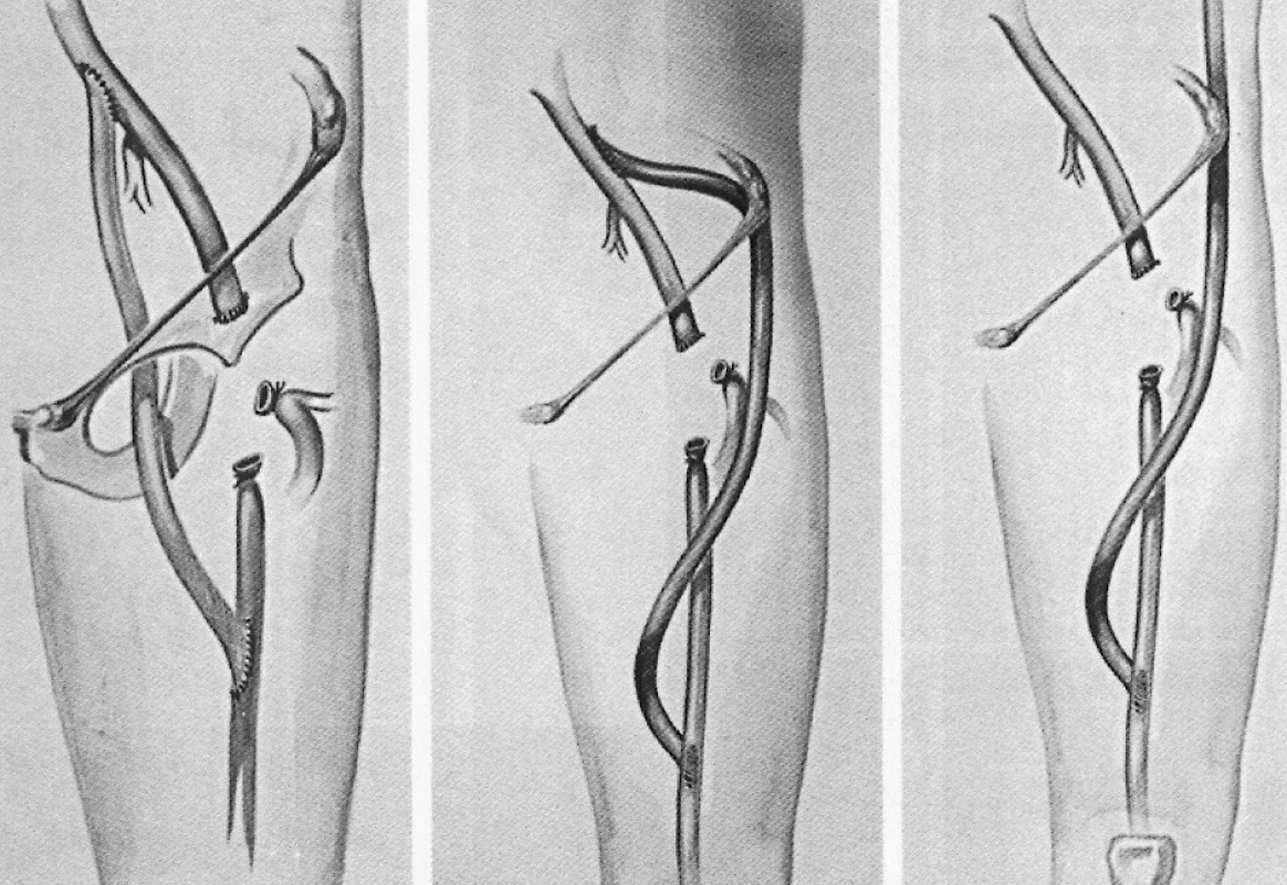 Možnosti extraanatomickej rekonštrukcie v oblasti stehna
Pic. 5. Options for extraanatomical reconstructions in the thigh region