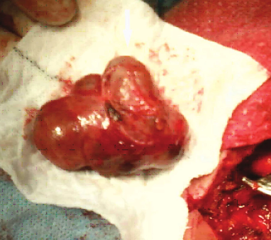 Odstraněný tumor