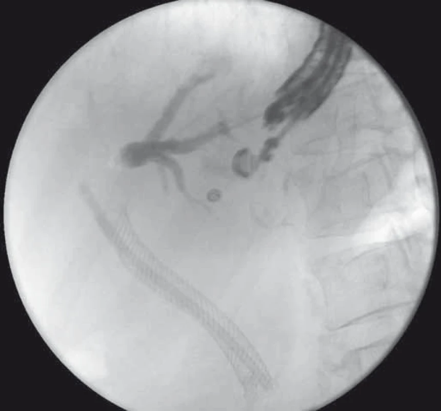 EUS-HGS – cholangiogram po transgastrickej punkcii ľavého ductus hepaticus u pacientky  s Klatskinovým tumorom, pôvodný SEMS a plastový stent v žlčovode.
Fig. 5. EUS-HGS – cholangiogram after transgastric puncture of the left hepatic duct in a patient with Klatskin tumour, SEMS and plastic stent in the bile duct.
