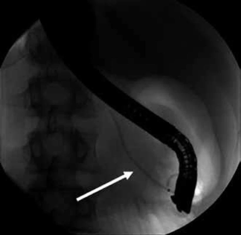 ERCP – zavedený stent do hlavního pankreatického vývodu, pohled zezadu (šipka).
Fig. 4. ERCP – stent in the main pancreatic duct, view from behind (arrow).