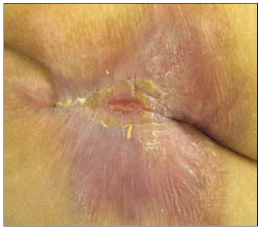 Case study A – after 5 months of
treatment – National Pressure Ulcer Advisory
Panel (NPUAP) I. category.<br>
Obr. 2. Klinický prípad A – po 5 mesiacoch
liečby, dekubitus I. stupeň podľa
National Pressure Ulcer Advisory Panel
(NPUAP).