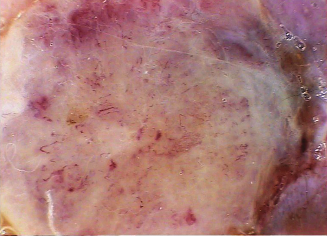 Středně silný melanom (Breslow 1,8 mm)
Dermatoskopicky je nápadný cévní polymorfismus na bělavém pozadí léze.