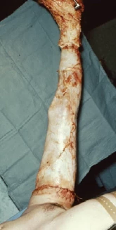 Ischemisation of lower limb and fascia-deep removal of aff ected tissue.