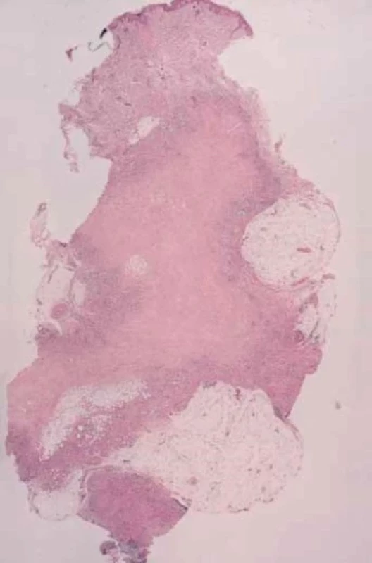 Revmatoidní uzel – histologický obraz – oblasti degenerace kolagenu zahrnující hlubší dermis a zasahující do septa podkožního tuku (převzato z 6)
