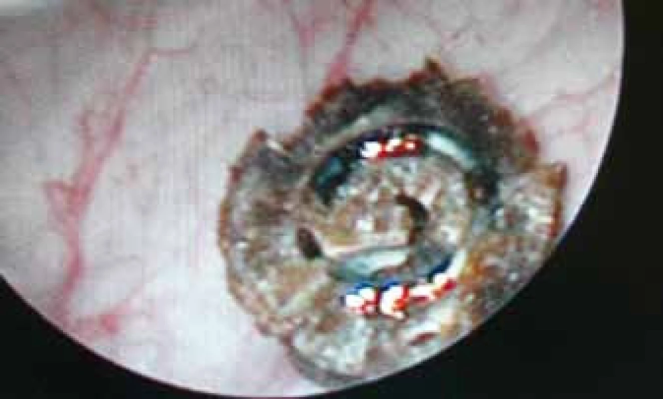 Peroperační obraz spirály v močovém měchýři
Fig. 3. Intraoperative image of tacker in the urinary bladder
