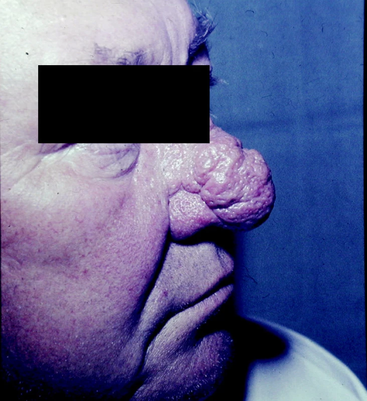 Rhinophyma.