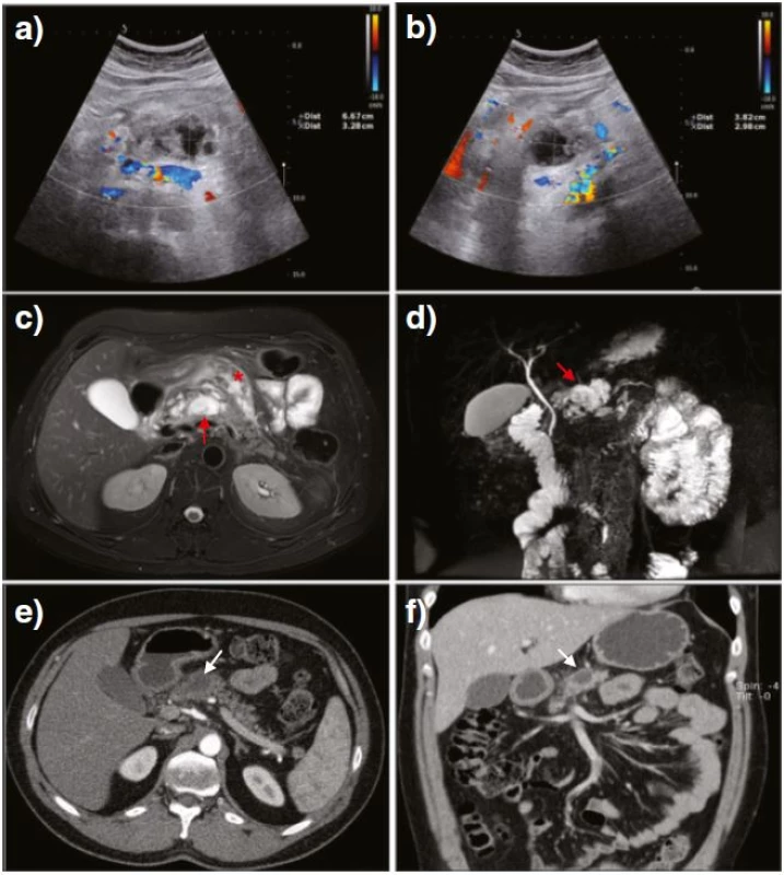 US after the diagnostic angiography revealed a progressive decrease of the serpinginous formations as well as a cystic lesion gradually increasing in size (a, b). Fat-suppressed <i>T<sub>2</sub></i>-weighted MR images depicted fluid characteristics in the neck of the pancreas (c, <i>red arrow</i>) and in the peripancreatic fat (c, <i>red asterisk</i>) indicating an area of intra-parenchymal necrosis along with some peripancreatic edema. MR cholangiopancreatography confirmed minor peripancreatic fluid collection in the neck of the pancreas (d, <i>red arrow</i>). Long-term CT follow-up showed no evidence of previous vascular malformation along with the remaining peripancreatic fluid collection (e, f, <i>white arrows</i>)