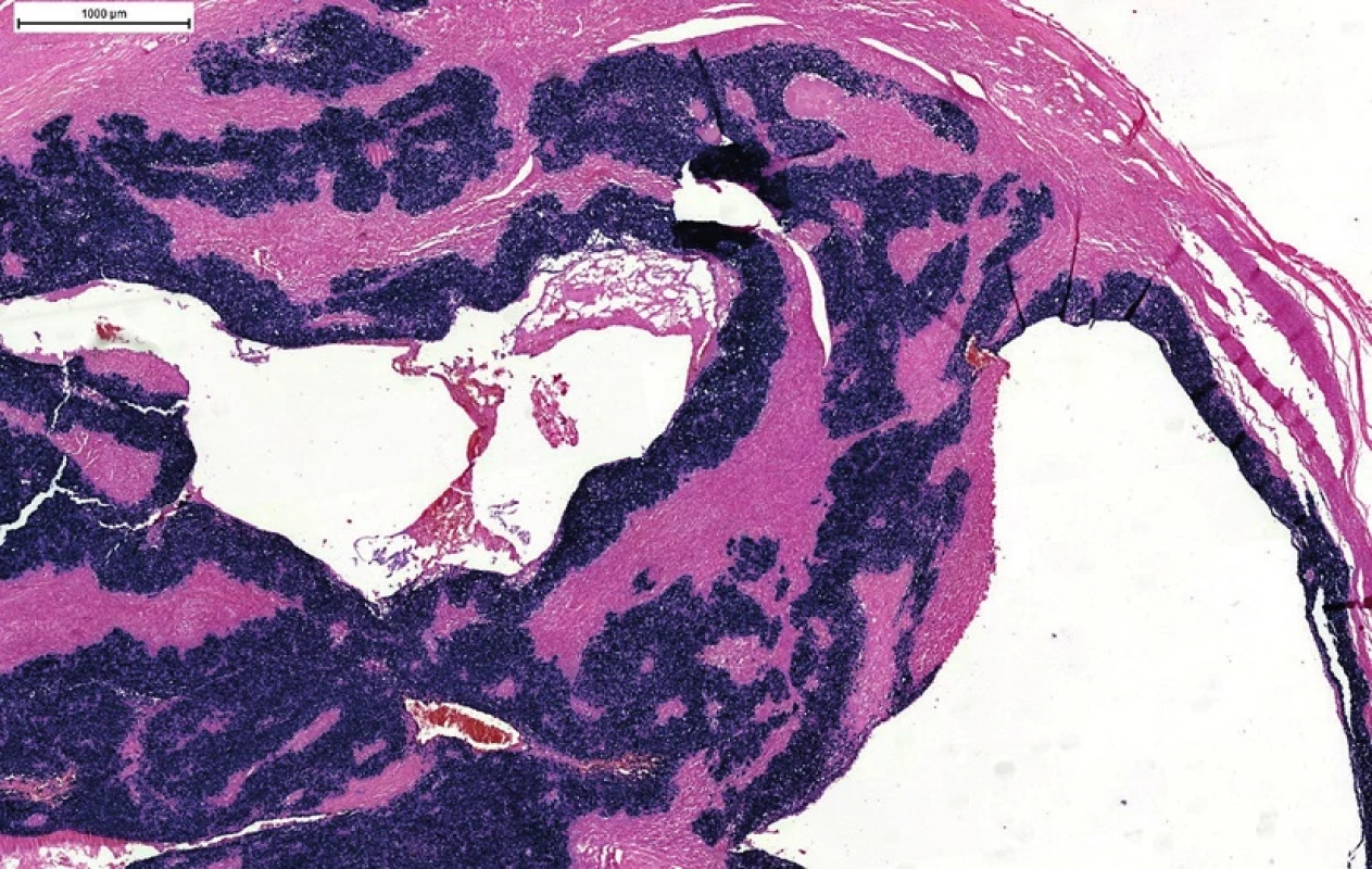 EBV in situ hybridizácia (EBER). Typická pozitivita vo všetkých nádorových bunkách v cystickej metastáze z neznámeho origa. Pridanie testu na prítomnosť EBV v prípade p16/HPV-negatívnej metastázy môže v časti prípadov odhaliť okultné origo v nazofaryngu.