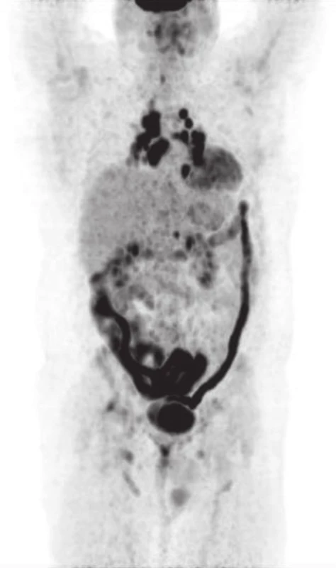 Pacient č.2, III/2013 PET/CT (MIP).
