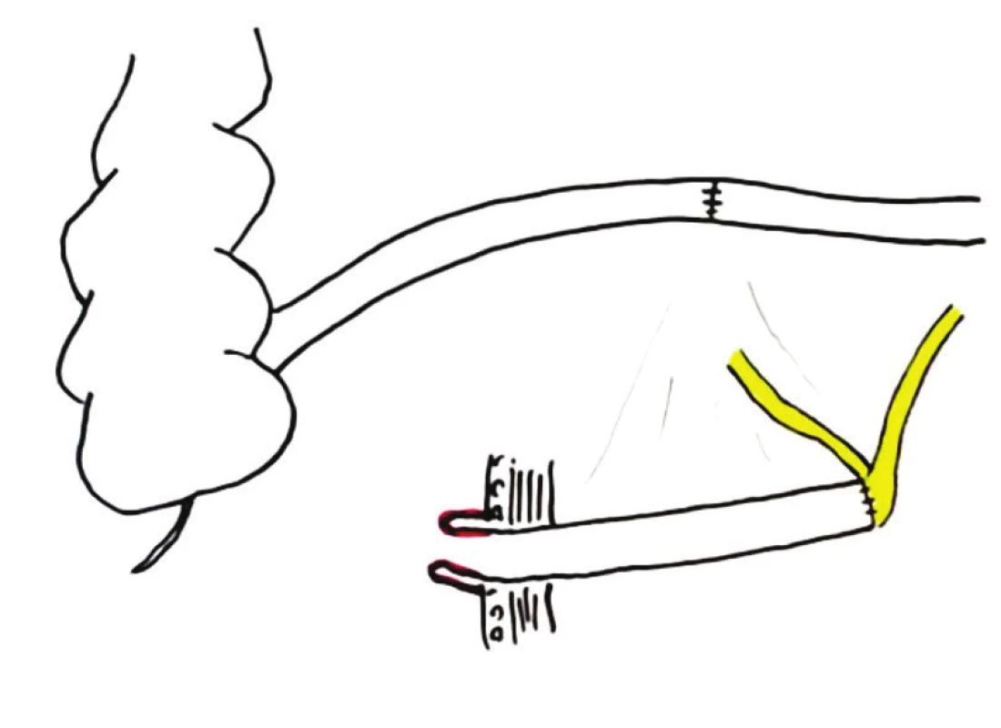 Ureteroileální konduit (kutánní ureteroileostomie) – schéma
Fig. 2: Ileal conduit diagram
