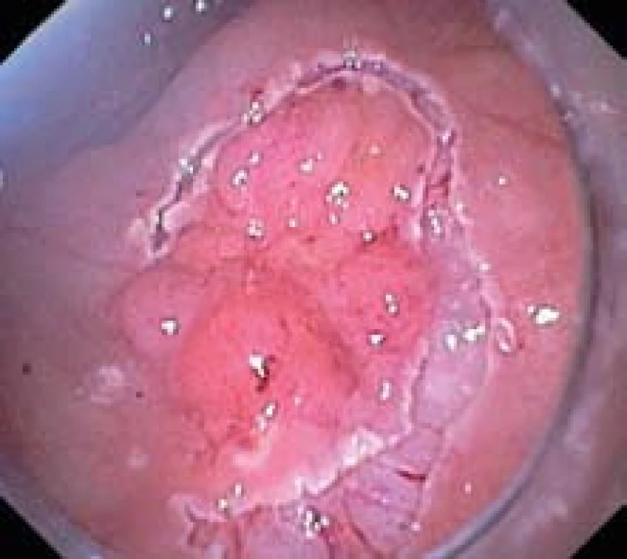 Neúplná cirkulární incize kolem léze.
Fig. 3. Incomplete circular incision around lesion.