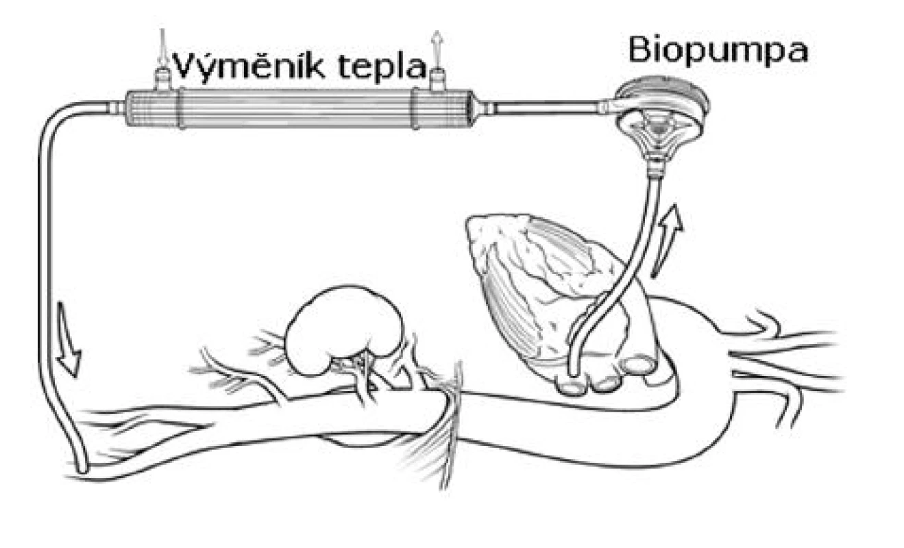 Levostranný srdeční bypass (schéma)
Fig. 4. Left heart bypass (a schematic diagram)