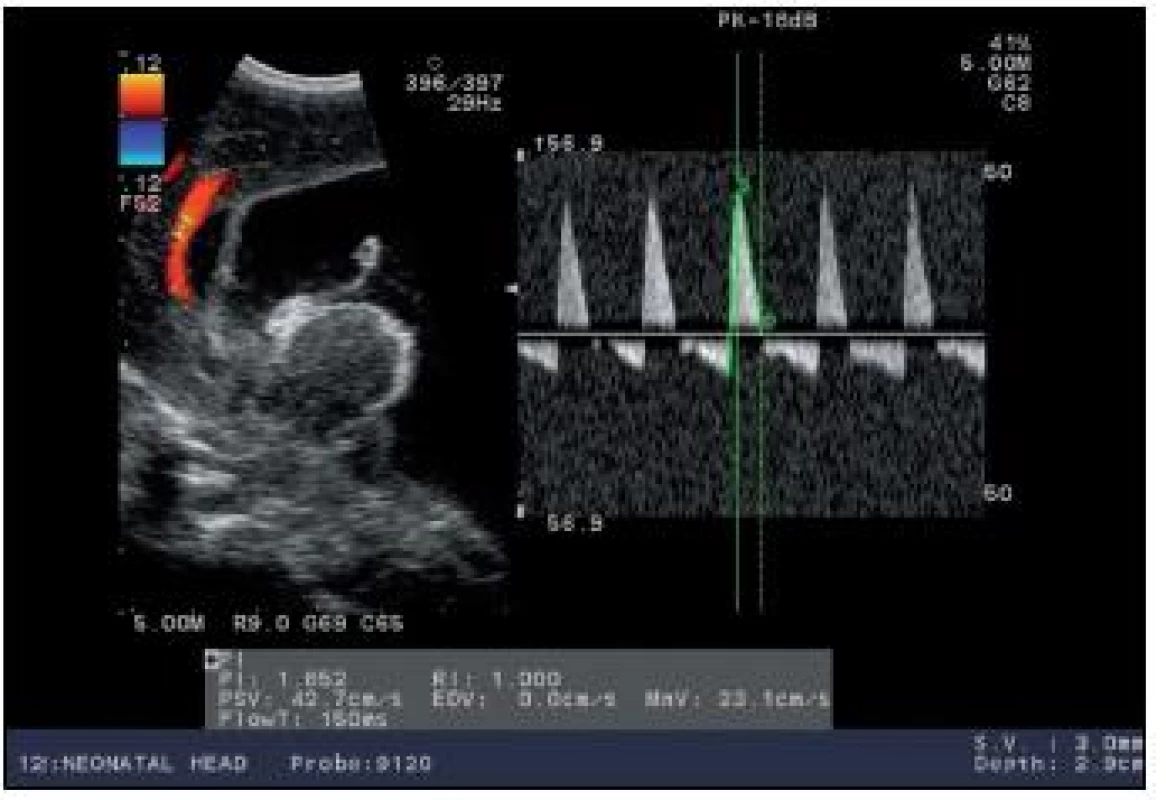 Dopplerovská krivka a. pericallosa u novorodenca s hydrocefalom pred drenážnym výkonom, kompresívny test na prednej fontanele – reverzný tok krvi počas diastoly.
Fig. 4. Doppler curve and cisterna pericallosa in a newborn with hydrocephalus before the drainage intervention, compressive test on the frontal fontanelle – reverse blood flow during diastole.