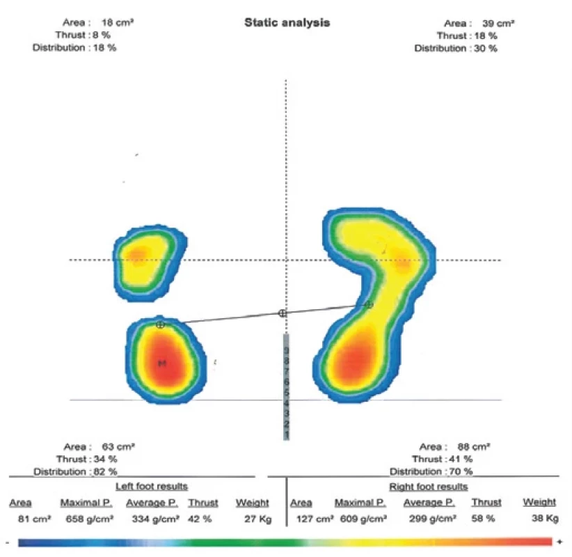 Static plantar pressure measurement.