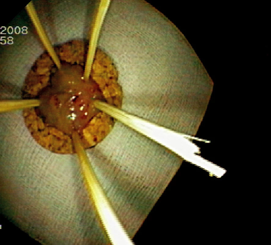 Fixace resekátu na korkové podložce (histologicky „serrated adenoma“)
Pic. 5. Resected specimen fixed on a corc board