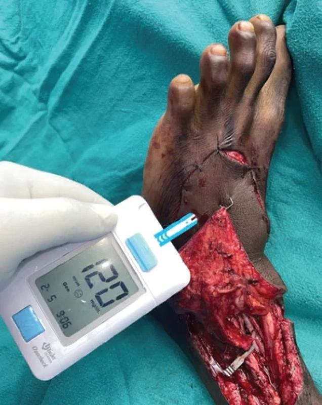 Anterolateral thigh fl ap after inset.