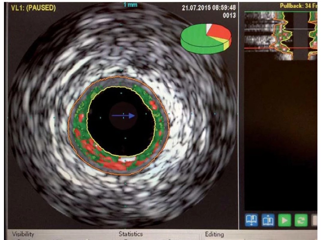 IVUS – virtuální histologie, zeleně fibrózní tkáň, červeně nekrotické jádro plátu, bíle kalcifikace.