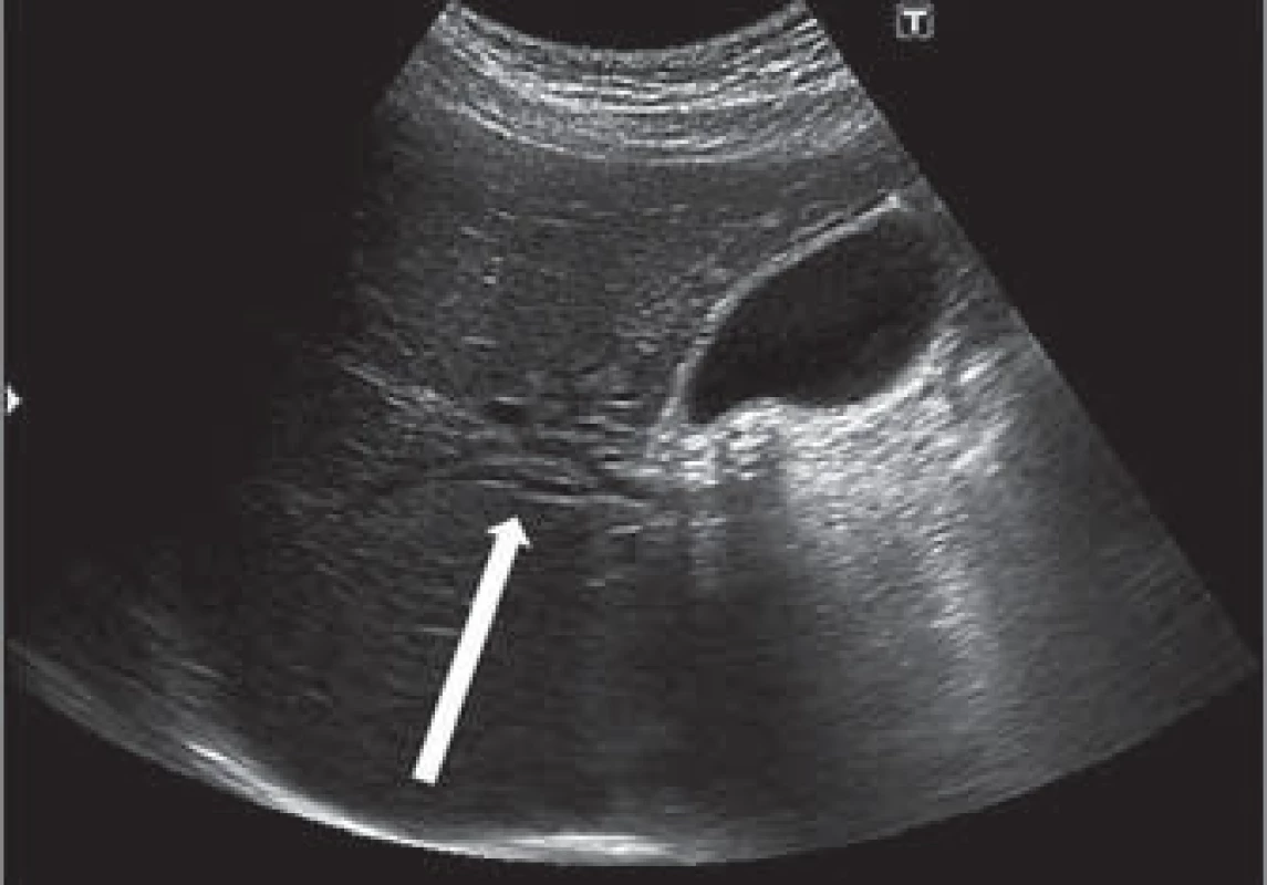 Sonografický obraz dilatace nitrojaterních žlučovod  (šipka).
Fig. 2. Ultrasound image of intrahepatic bile duct dilatation (arrow).
