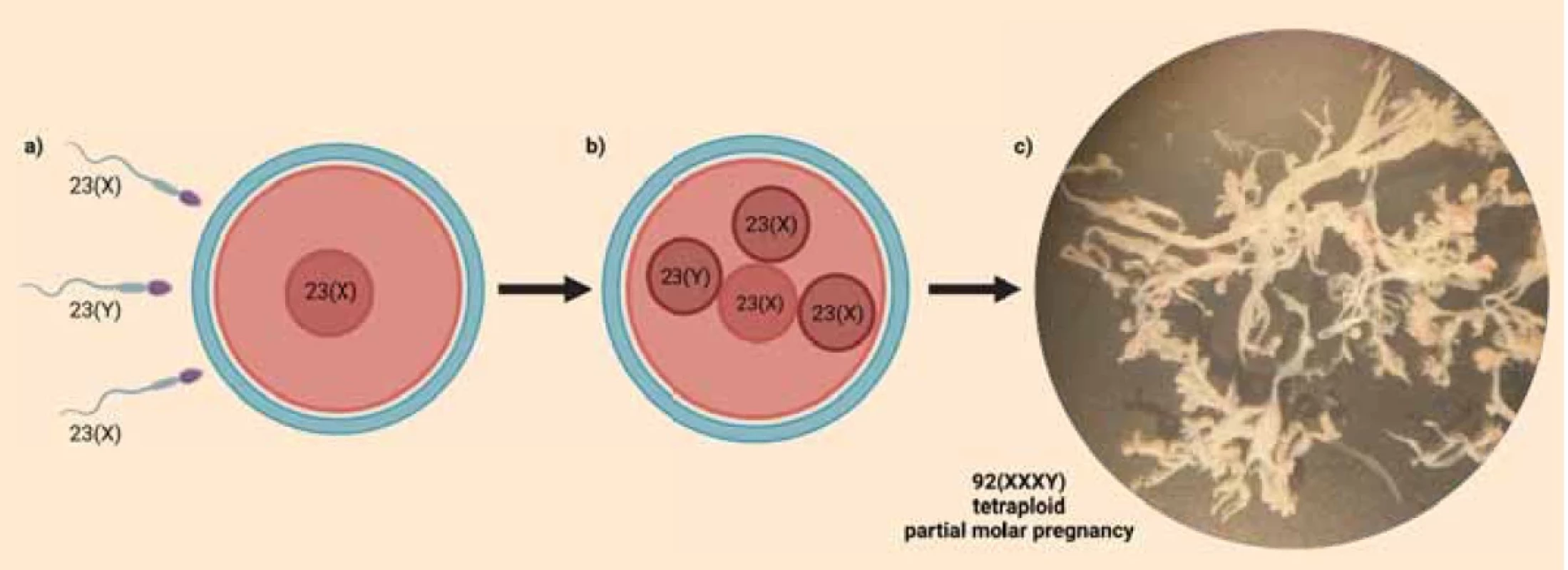 Mechanism of fertilisation and morphology of the presented tetraploid partial hydatidiform mole (Created with BioRender.com). </br>a) Fertilisation of the ovum by three sperms.</br>b) Zygote containing three paternal and one maternal sets of chromosomes.</br>c) Dissected – cleaned chorionic villi before DNA isolation under binocular loupe showing marked hydrops and absence of vascularisation (Photographed at Institute of Medical Biology, Genetics and Clinical Genetics, Faculty of Medicine, Comenius University Bratislava).
