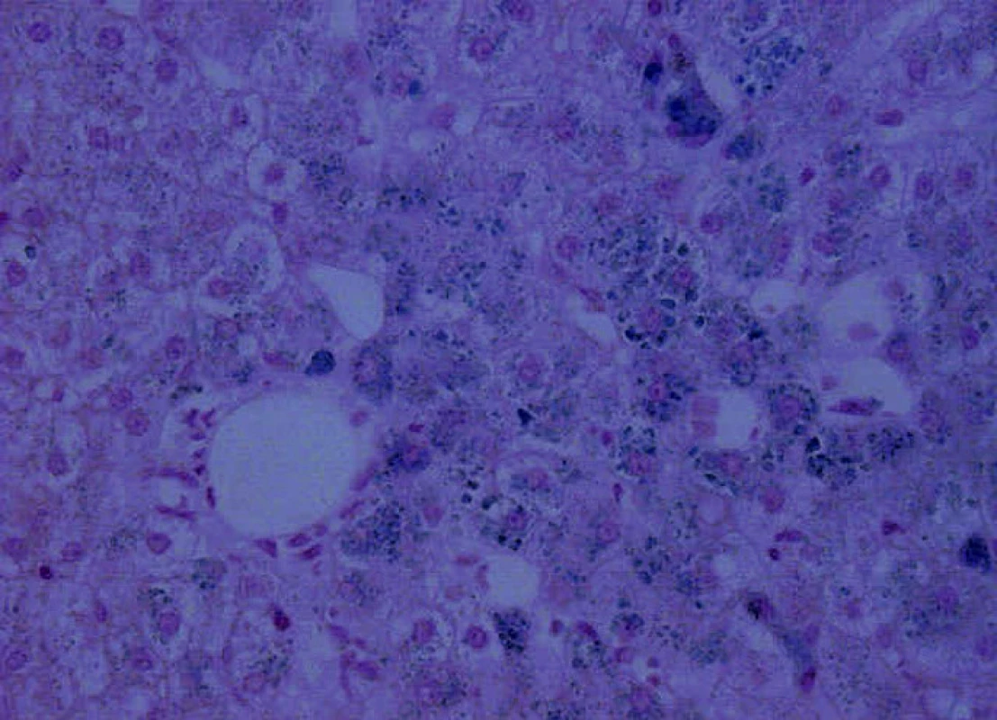 Jaterní biopsie, Fe, 200x – mírná steatóza, hemochromatóza, patrna hojná depozita
Fe pigmentu v hepatocytech i Kuppferových buňkách s intenzitou 4. stupně.