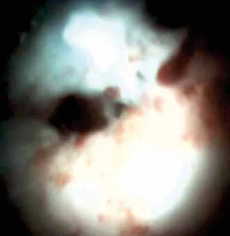 Pankreatoskopie. Stenóza pankreatického vývodu. Histologicky low-grade dysplazie, stejný nemocný jako na obr. 10.
Fig. 11. Pancreatoscopy. Stenosis of the pancreatic duct. Histologically low-grade dysplasia, the same patient as in fig. 10.