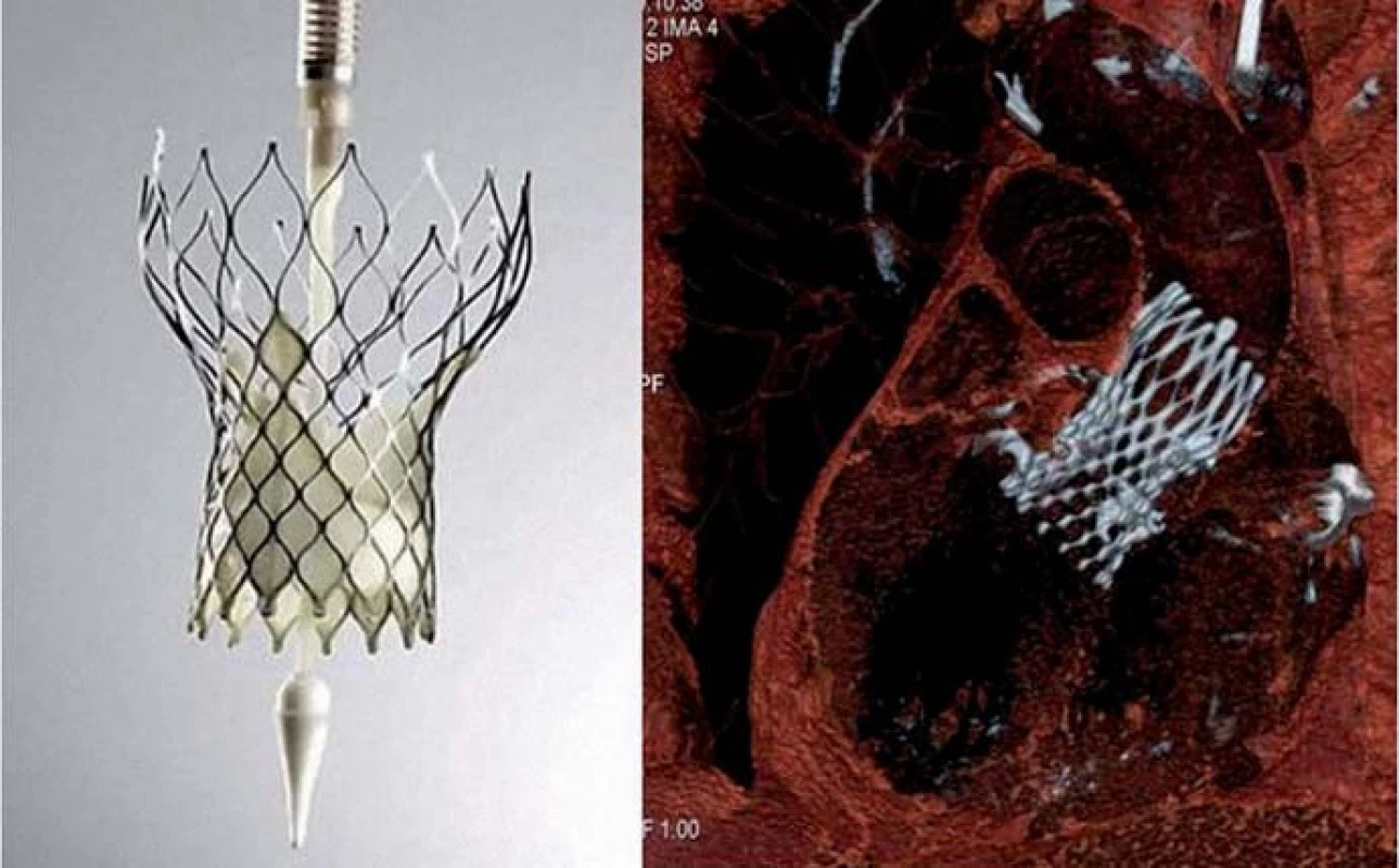 Protéza CoreValve ReValving třetí generace – vlevo ex vivo, vpravo na CT zobrazení in vivo (CT dokumentace laskavě poskytnuta MUDr. Markem Labošem, FN KV).