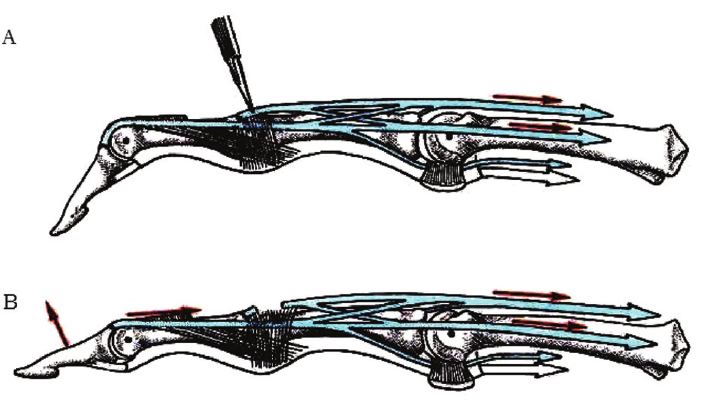 Tenotómia centrálneho pruhu extenzorového aparátu
a) transcízia centrálneho pruhu, b) proximálna retrakcia extenzorového aparátu [2]
Fig. 9: Tenotomy of the central strip of extensor apparatus
a) transcision of the central strip, b) proximal retraction of the extensor apparatus [2]