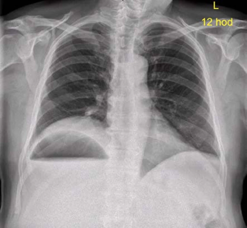 Zadopřední snímek hrudníku: nález široké hladiny pod pravou brániční klenbou
Fig. 1. Chest X-ray: an extensive hydroaeric phenomenon in the right subfrenic area