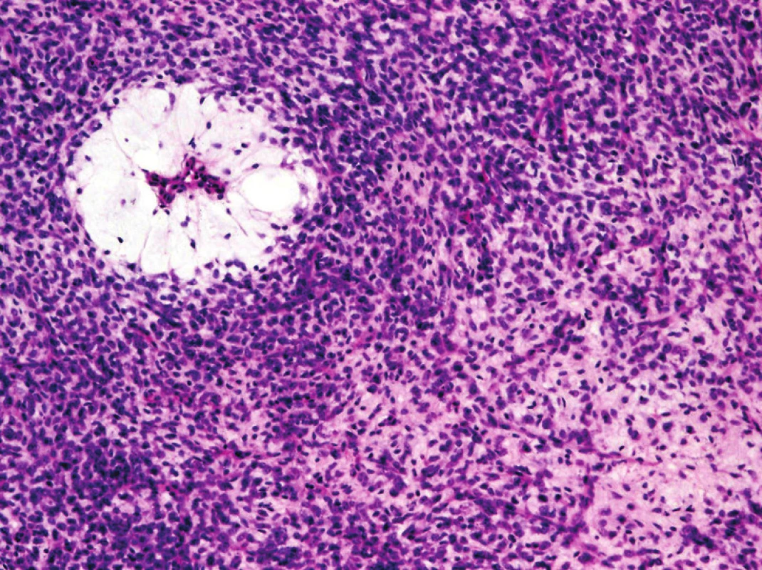 High-grade myxoidní liposarkom, dříve označovaný za kulatobuněčný liposarkom. Hypercelulární komponenta může být zastoupena v různém procentu nádorové tkáně, zprvu typicky v podobě perivaskulárních manžet (původní zvětšení 100x).