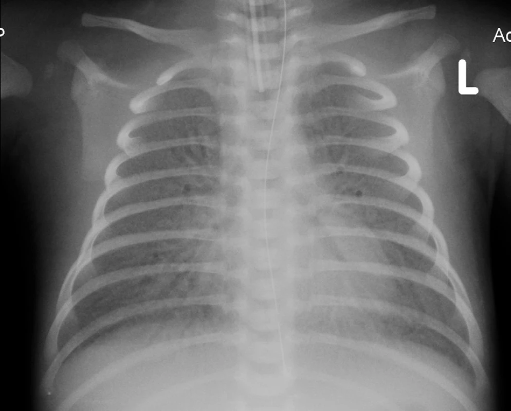 Rtg hrudníku – 12. den života.
Fig. 2. Chest X-ray – 12th day of life.